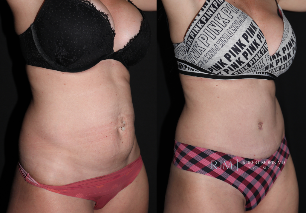 Abdominoplasty Photo Gallery