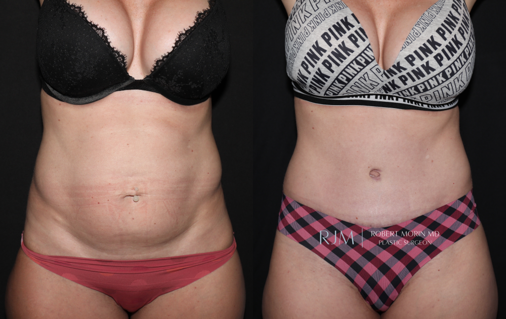  Woman's patient - body, before and after abdominoplasty treatment in New Jersey, front view