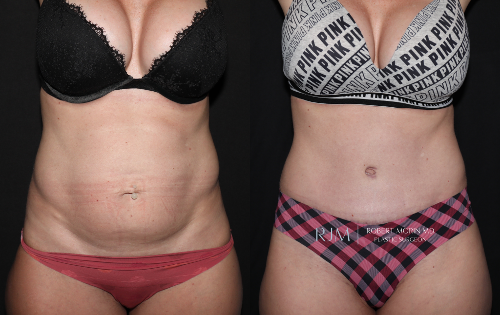 Abdominoplasty Photo Gallery