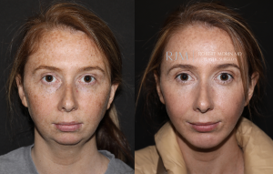  Womans face, before and after Genioplasty treatment in New Jersey, front view, patient 3