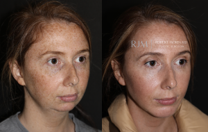  Womans face, before and after Genioplasty treatment in New Jersey, oblique view, patient 3