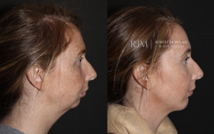  Womans face, before and after Genioplasty treatment in New Jersey, side view, patient 3