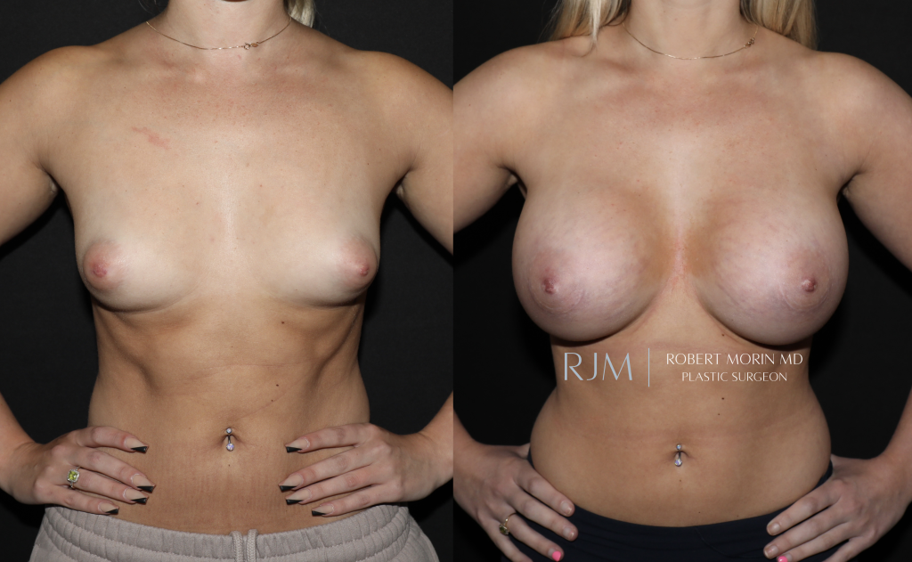  Before and after breast augmentation in New Jersey Robert Morin MD, front view, patient 8