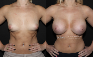  Before and after breast augmentation in New Jersey Robert Morin MD, front view, patient 8