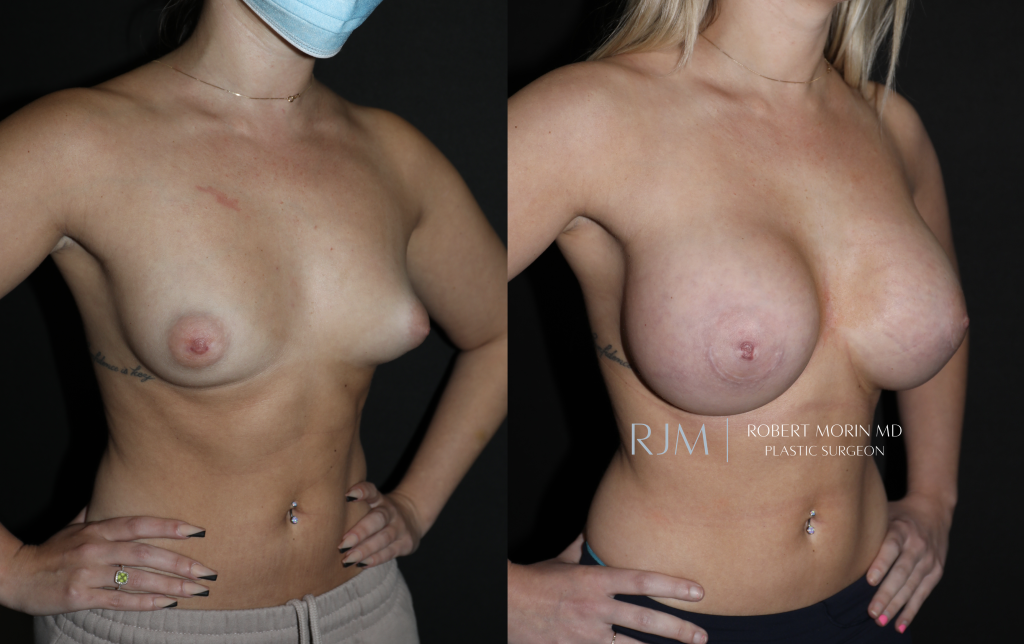  Before and after breast augmentation in New Jersey Robert Morin MD, oblique view, patient 8