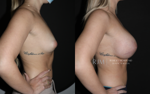  Before and after breast augmentation in New Jersey Robert Morin MD, side view, patient 8