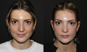  Before and after rhinoplasty Robert Morin MD