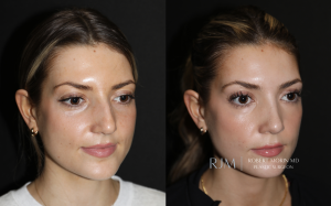  Before and after rhinoplasty Robert Morin MD