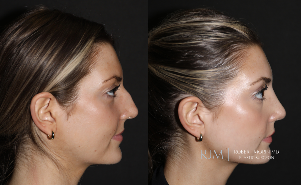  Before and after rhinoplasty Robert Morin MD