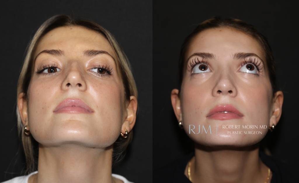  Before and after rhinoplasty Robert Morin MD