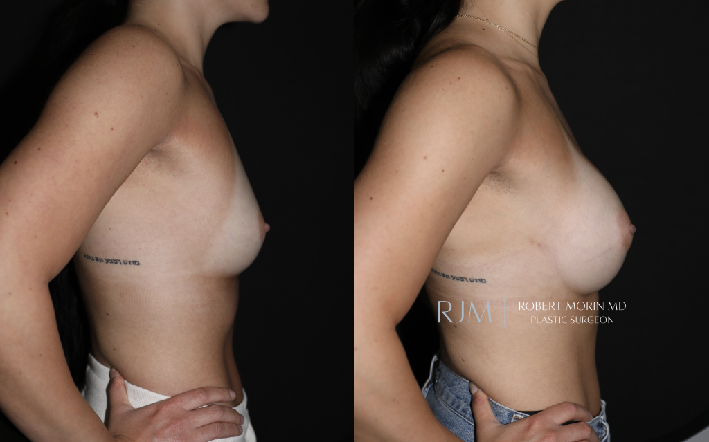  Before and after breast augmentation in New Jersey Robert Morin MD, r-side view, patient 7
