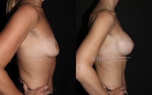 Breast lift in New Jersey before and after Robert Morin MD, patient 5, r-side view
