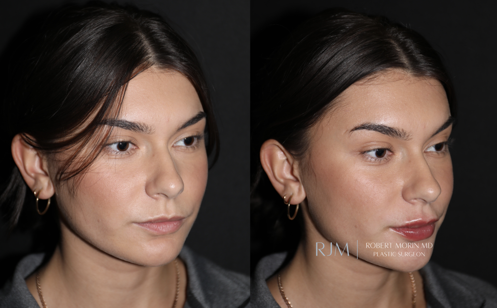  Woman face, Lip augmentation in New Jersey before and after Juvederm Robert Morin MD, oblique view, patient 2