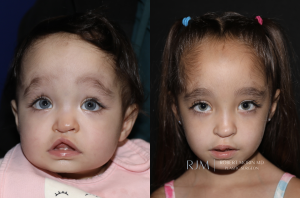  Cleft lip repair before and after Robert Morin MD