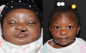  Cleft lip repair before and after photo Robert Morin MD