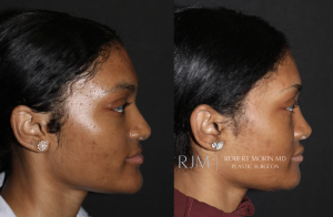  Womans face, before and after Genioplasty treatment in New Jersey, side view, patient 4