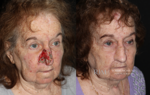  Female face, before and after Mohs/Skin Cancer Reconstruction treatment in New Jersey, oblique view, patient 2