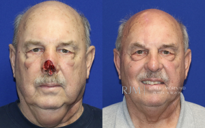  Male face, before and after Mohs/Skin Cancer Reconstruction treatment in New Jersey, front view, patient 1