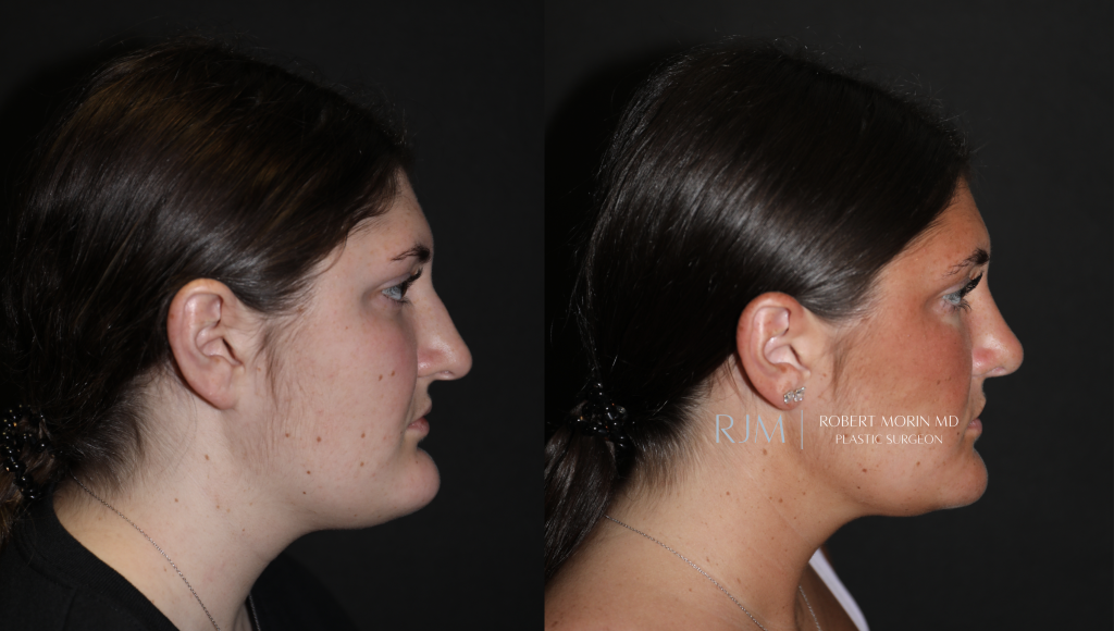  Reduction genioplasty, rhinoplasty, liposuction neck