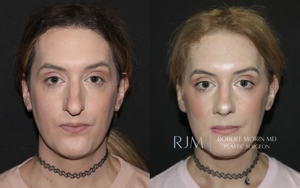  Transgender male to female FFS rhinoplasty 1