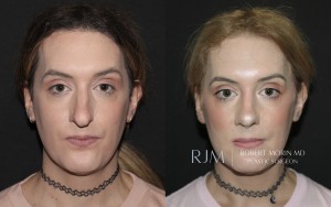  Transgender male to female FFS rhinoplasty 1