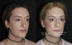  Transgender male to female FFS rhinoplasty 2