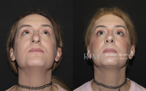  Transgender male to female FFS rhinoplasty 4