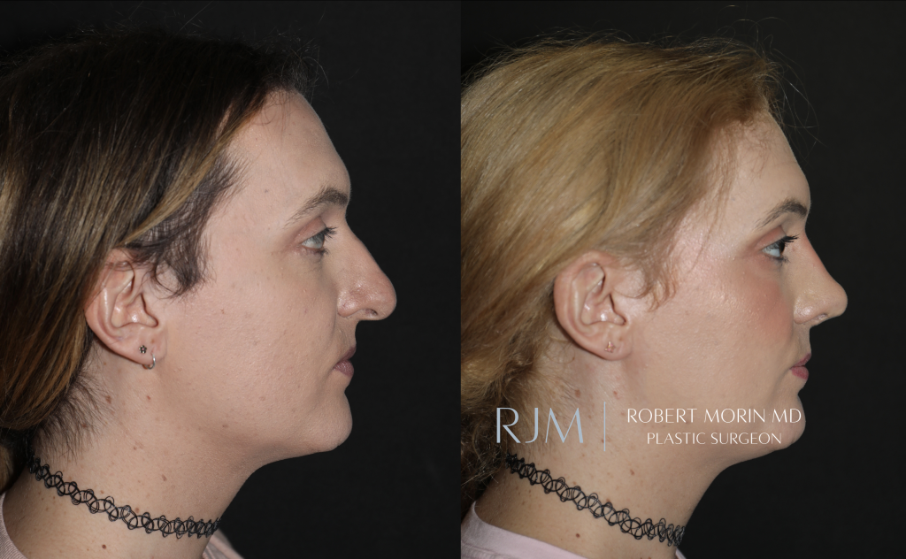  Transgender male to female FFS rhinoplasty 3