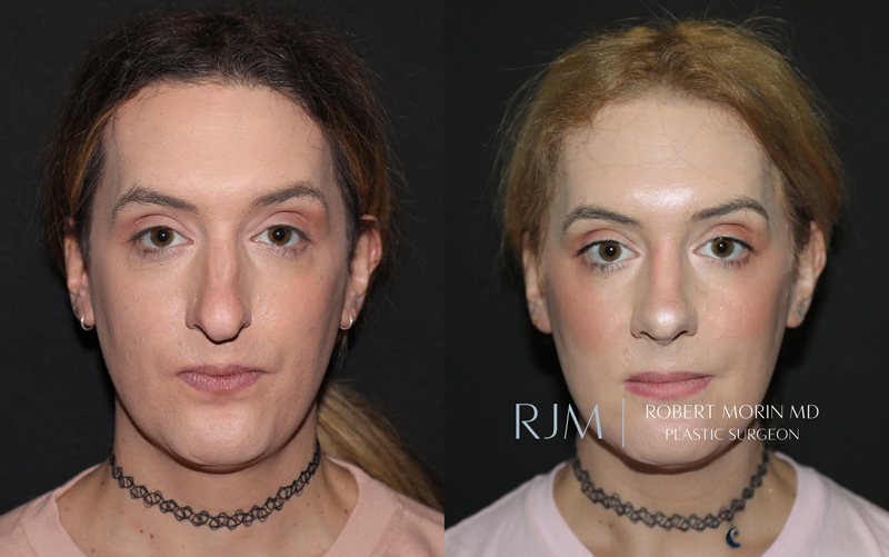 Facial Feminization Surgery Methods
