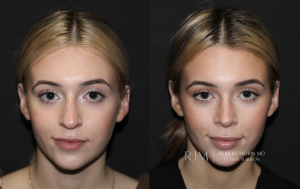  Beautiful before and after rhinoplasty Robert Morin MD