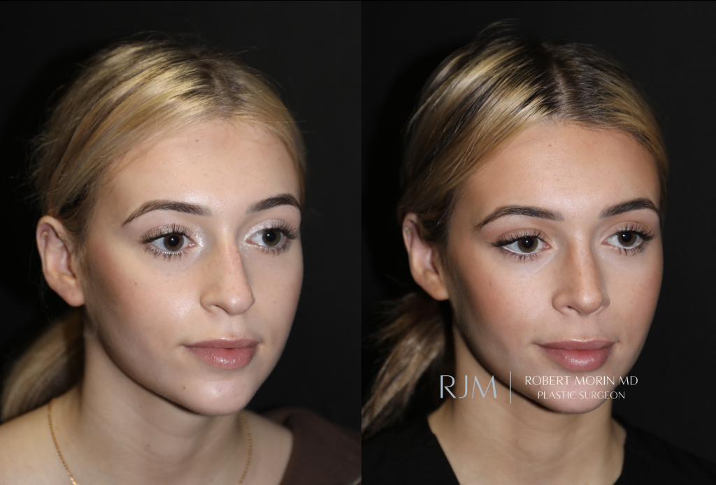  Beautiful before and after rhinoplasty Robert Morin MD