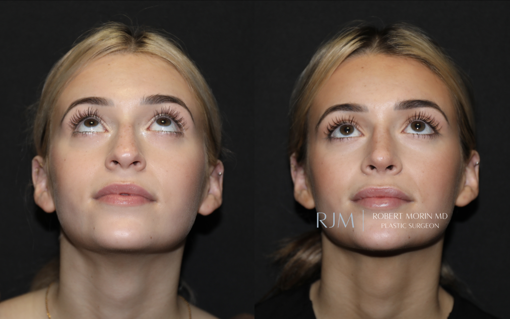  Beautiful before and after rhinoplasty Robert Morin MD