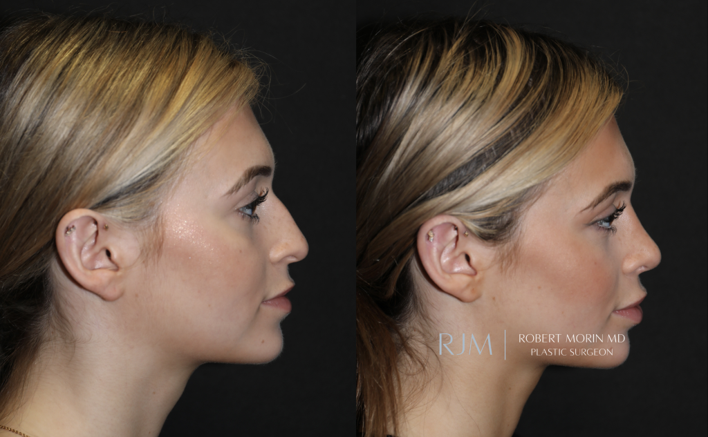  Beautiful before and after rhinoplasty Robert Morin MD