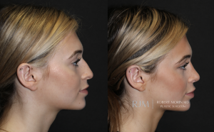  Beautiful before and after rhinoplasty Robert Morin MD