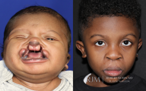  Cleft lip before and after 7 years