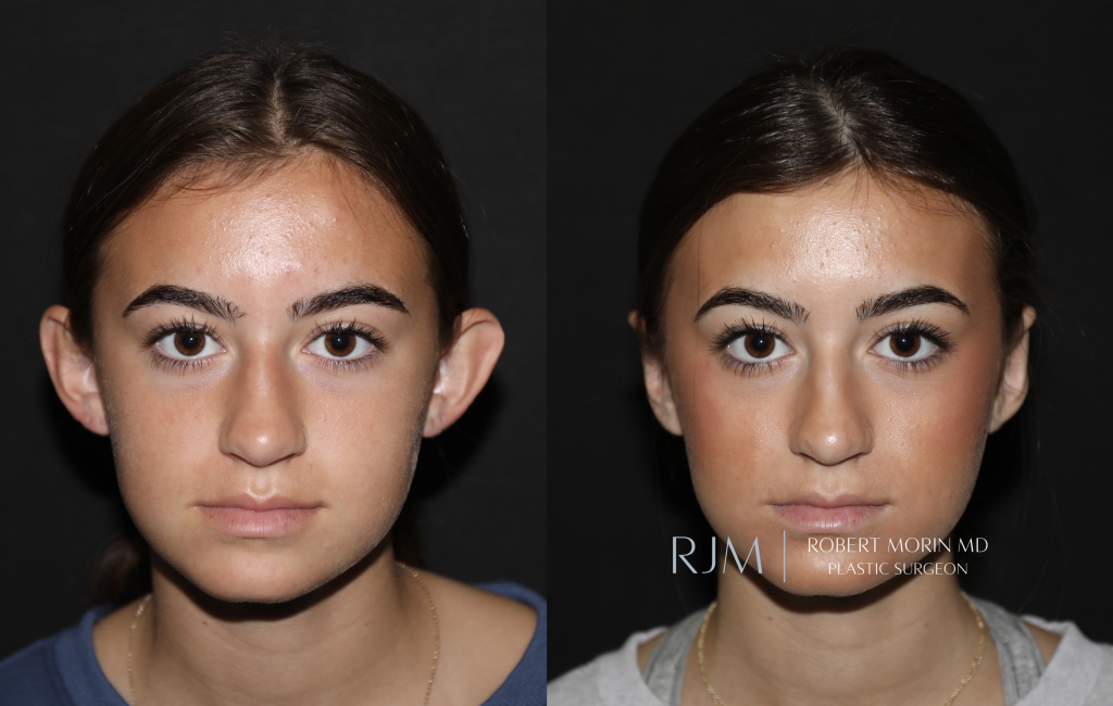  Otoplasty before and after Robert Morin MD