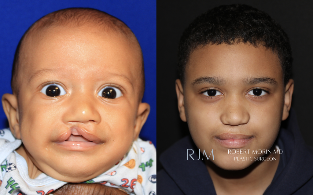  Cleft lip before and 10 years after