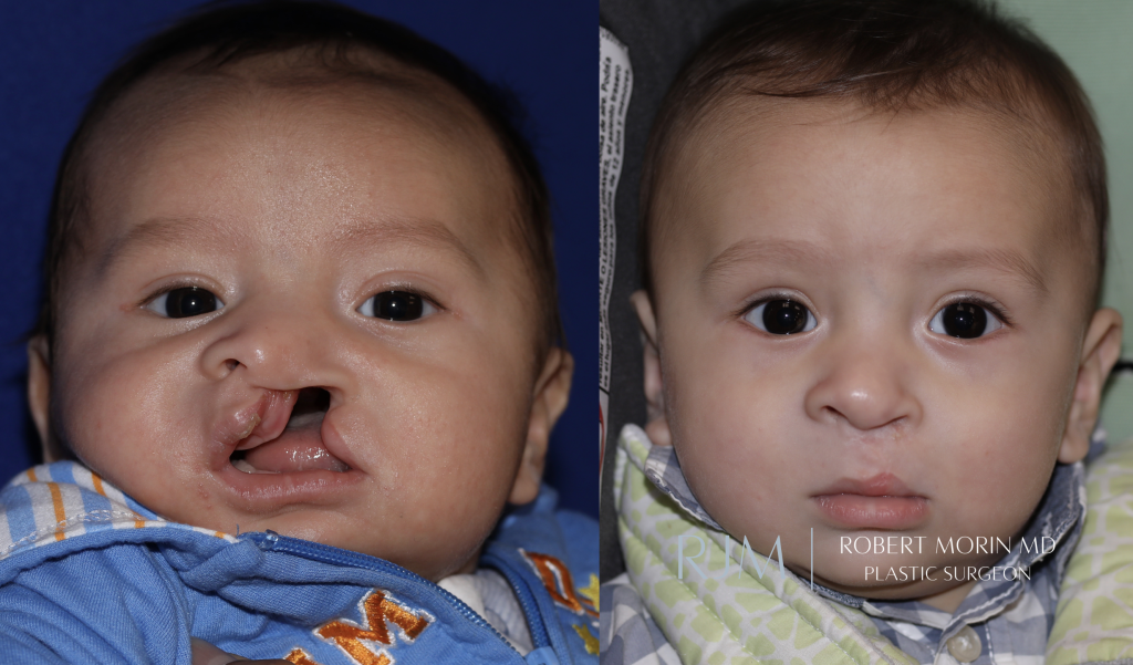  Cleft lip repair unilateral complete before and after Dr. Robert Morin