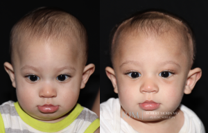  Metopic craniosynostosis before and after