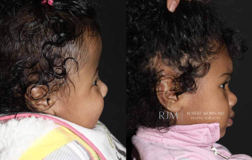  Bilateral coronal craniosynostosis before and after