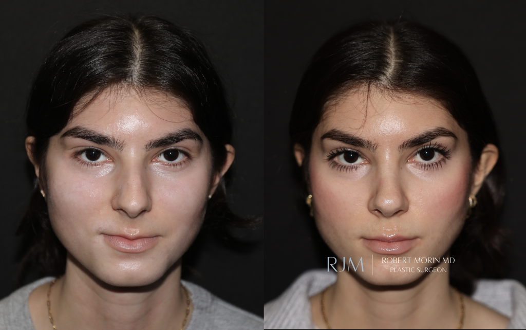  Robert Morin MD rhinoplasty NJ before and after