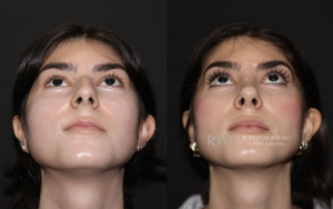  Robert Morin MD rhinoplasty NJ before and after