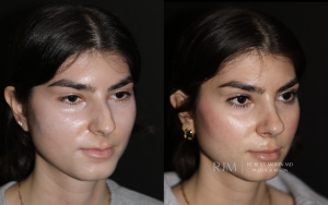  Robert Morin MD rhinoplasty NJ before and after