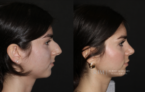  Robert Morin MD rhinoplasty NJ before and after