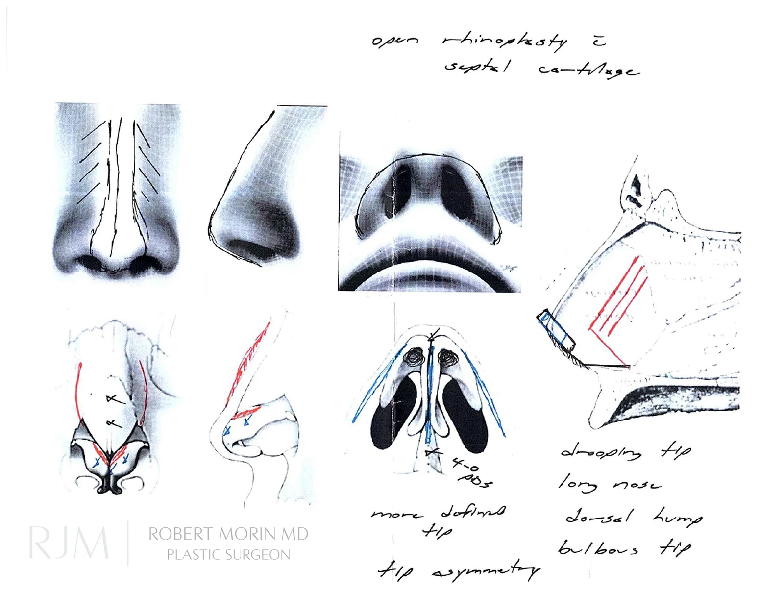Dr Morin Illustration of Rhinoplasty and Septoplasty Technique 