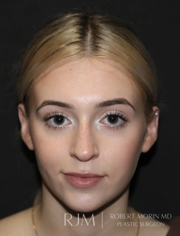 Dr Morin Patient Before Rhinoplasty Case Study 3