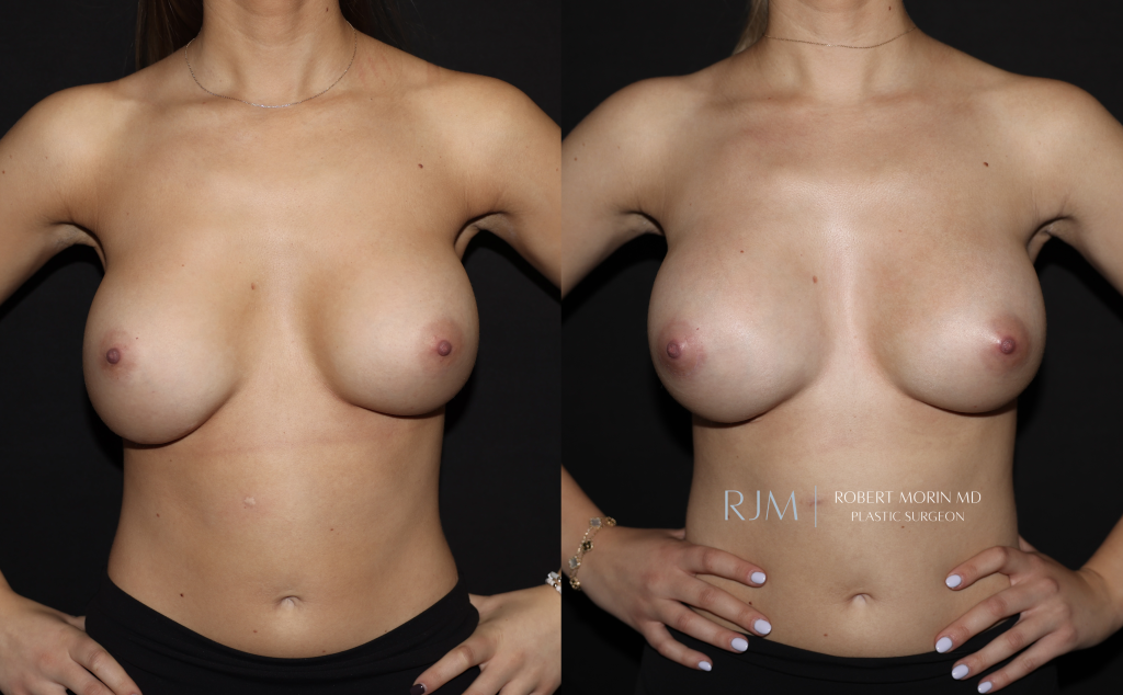  Revision breast augmentation before and after Robert Morin MD Correction of Implant Malposition front view