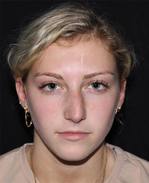 Dr Morin Rhinoplasty Case Study #1