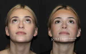  rhinoplasty patient 7 above ba