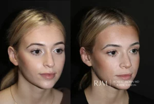  rhinoplasty patient 7 right front oblique ba
